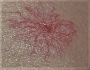 microspaidervein