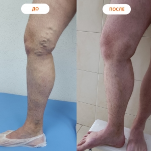 Флебология - результаты лечения До и После